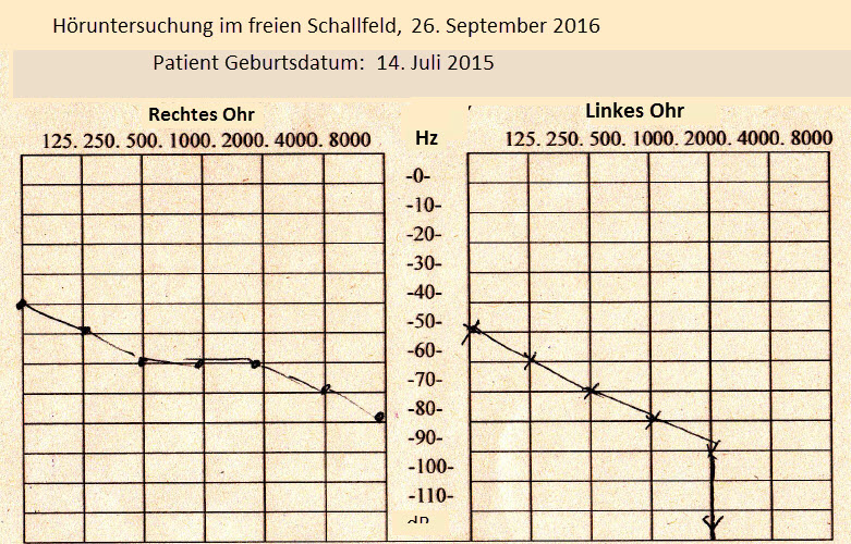 20160929 audiogramm vor HG.jpg